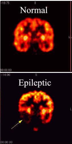Obat Epilepsi Tradisional